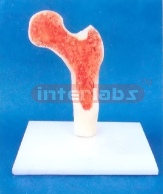 MIDDLE MORBIDITY FEMUR BONE MODEL SHOWING DISEASES